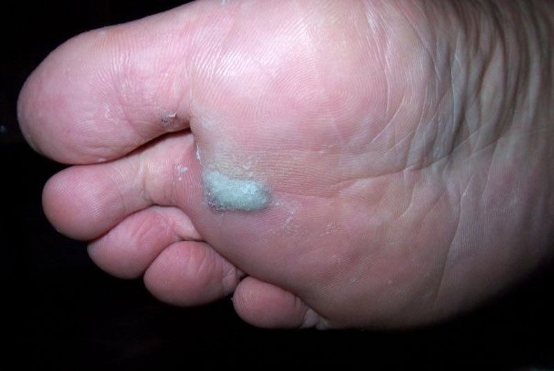 Gerry's blister